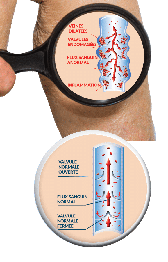 découvrez ce que signifient les veines saillantes, leurs causes, et comment les traiter. informez-vous sur les facteurs de risque et les solutions pour améliorer votre circulation sanguine et la santé de votre peau.