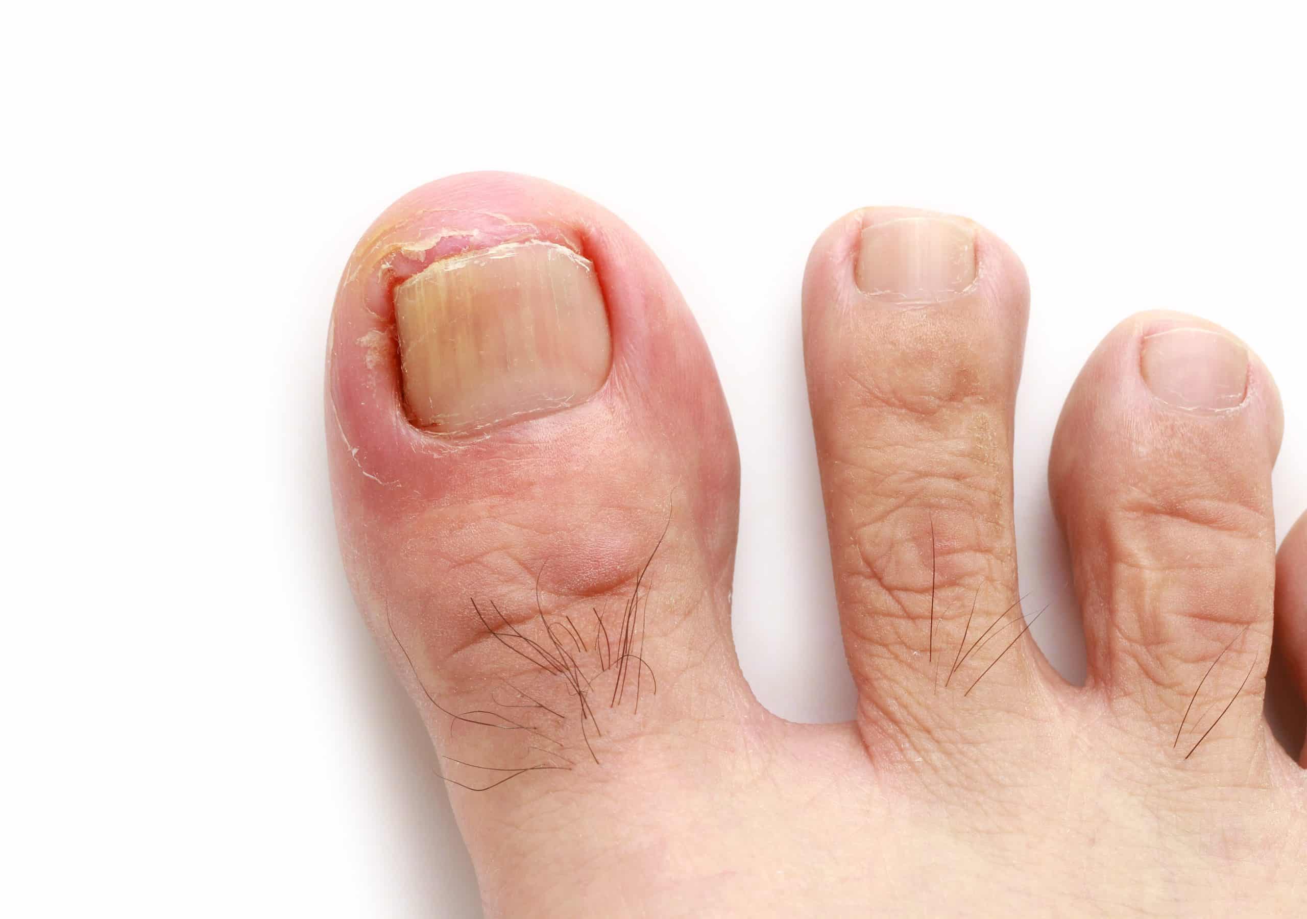 découvrez les causes des ongles de pied épais et les solutions efficaces pour y remédier. apprenez à prendre soin de vos ongles et à retrouver leur santé grâce à nos conseils pratiques.